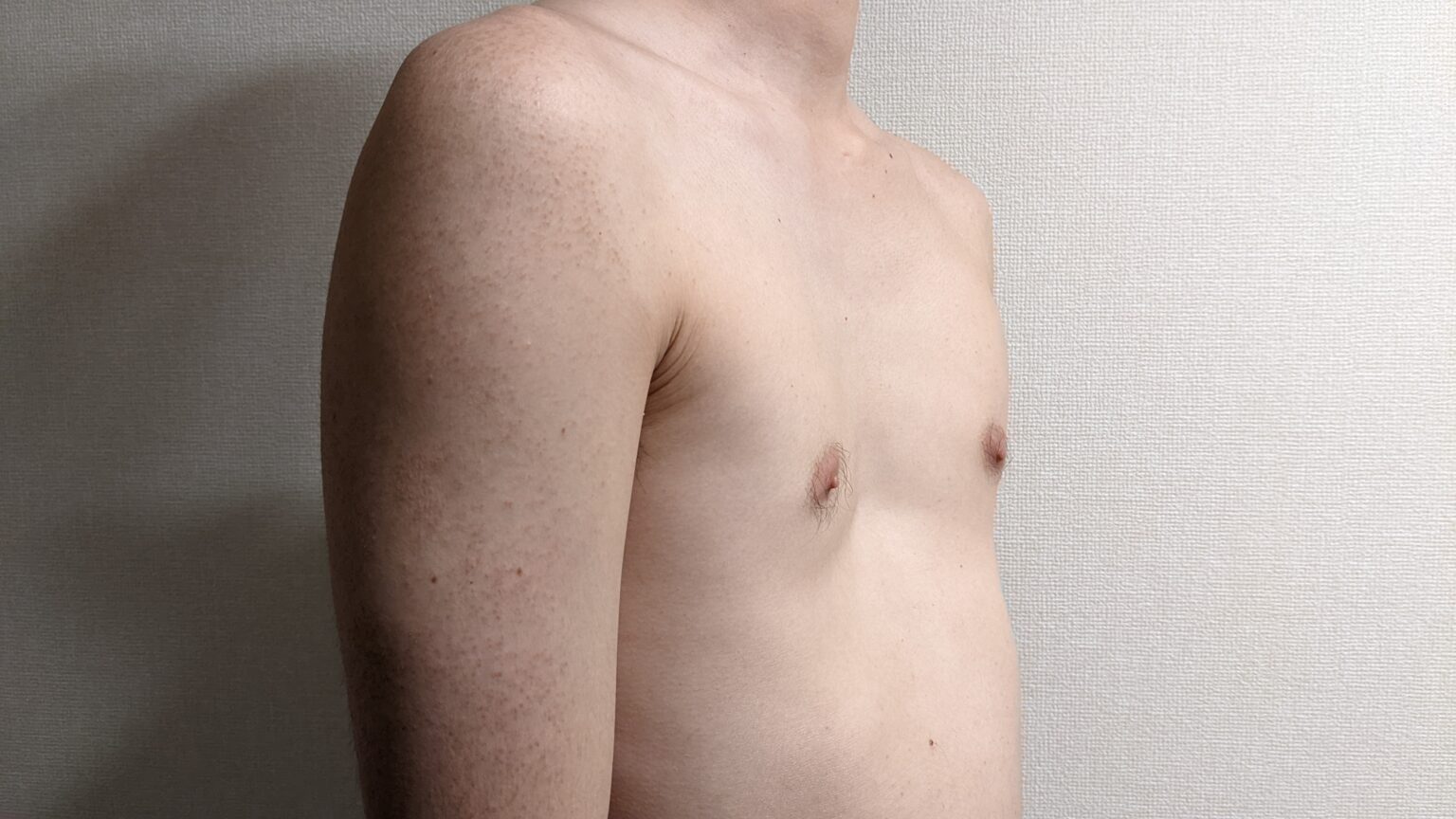 挺起胸膛做人—超微创矫形术治疗漏斗胸 - 知乎